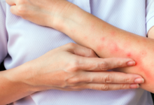 Natural Ways to Soothe Bed Bug Bites Fast