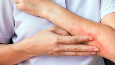 Natural Ways to Soothe Bed Bug Bites Fast