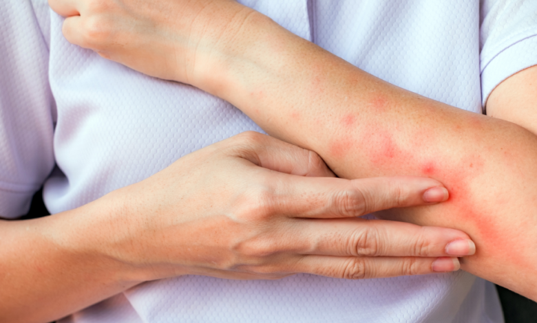 Natural Ways to Soothe Bed Bug Bites Fast